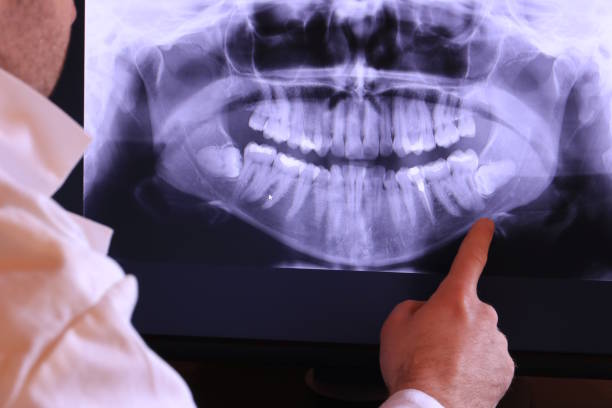 Best Knocked-Out Tooth (Avulsed Tooth) Treatment in Smith Mills, MA